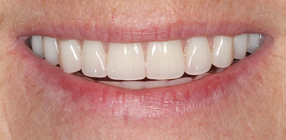 Dental Implant after