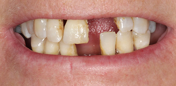 Dental Implant before
