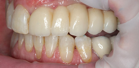 Dental Implant after