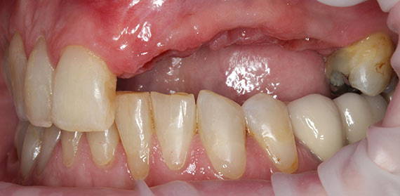 Dental Implant before