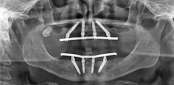 Xray after implants