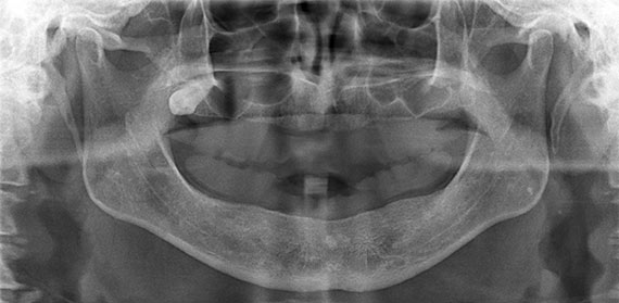 Xray before implants
