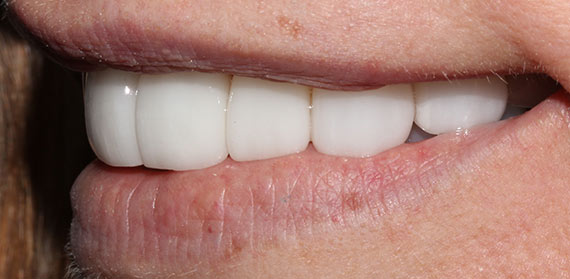 Dental work after