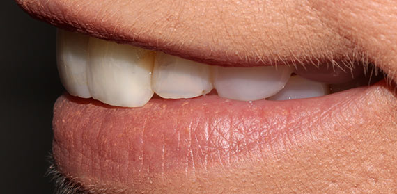 Dental work before