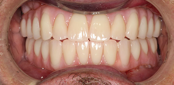 Dental Implant after