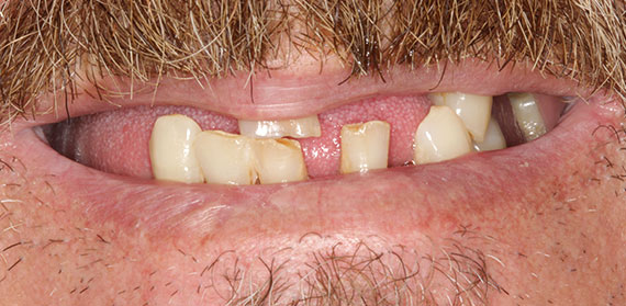 Dental Implant before