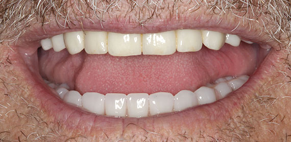 Dental Implant after