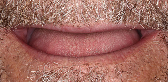 Dental Implant before