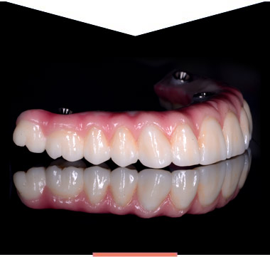 All on 4 full set of teeth