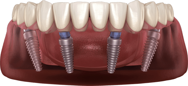 The Sydney Implant Institute