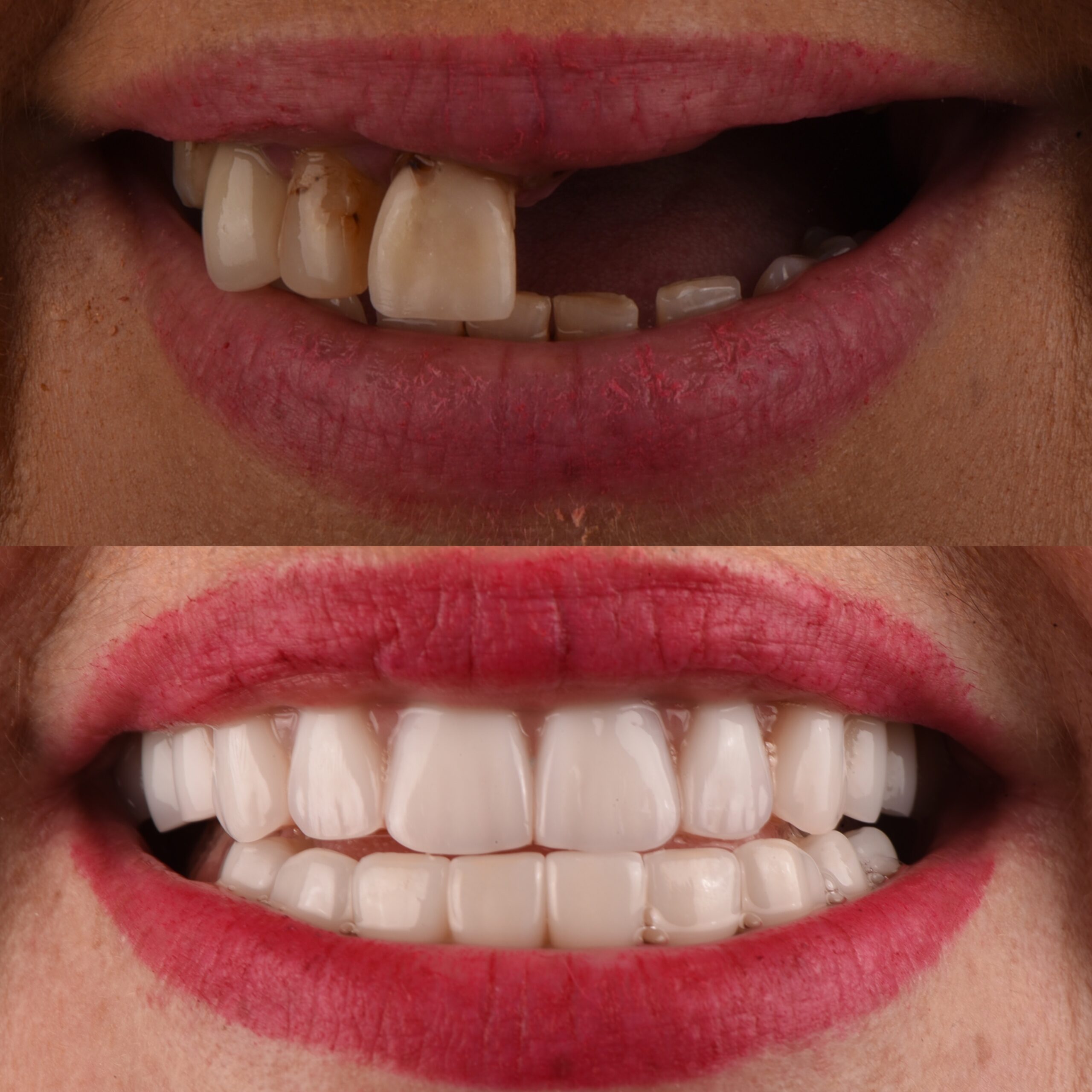 Cost of Dental Implants and All on 4 Payment options and packs