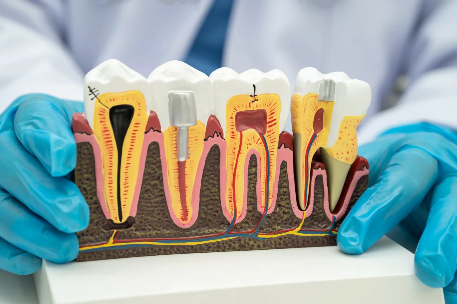 Dental Implants VS Root Canal Treatment (1) Dental Implants VS Root Canal Treatment (1)